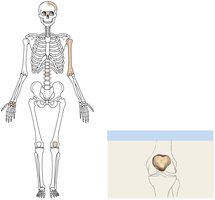 Sesamoid bone example: patella
