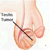 Testicular tumor illustration