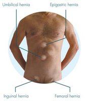 Types of hernias including inguinal hernia