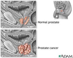 Normal prostate vs. prostate cancer