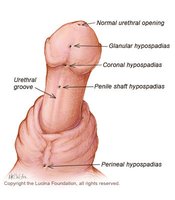Types of hypospadias