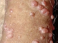 Genital warts caused by HPV