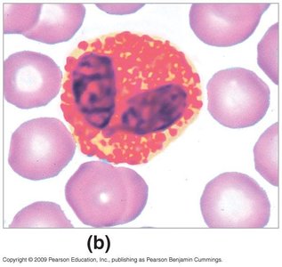 Eosinophil with bilobed nucleus and orange granules