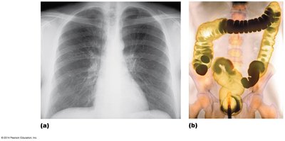X-ray images of chest and lower GI tract