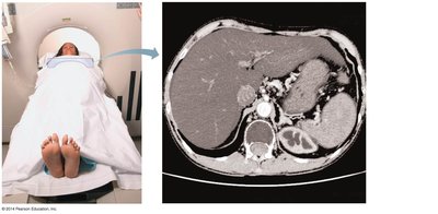CT scan of the abdomen