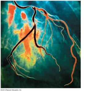 Digital subtraction angiography of coronary arteries