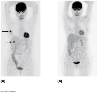 PET scans before and after treatment