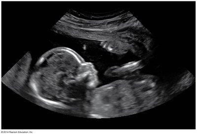 Ultrasound image of a fetus in the uterus