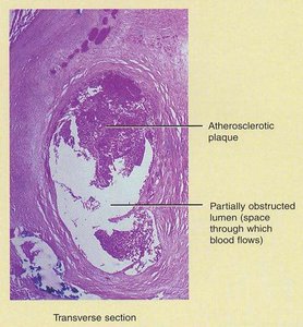 Atherosclerotic plaque in coronary artery