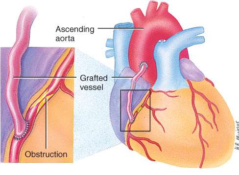 Bypass graft (CABG)