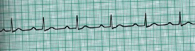 Normal, bradycardia, tachycardia ECG