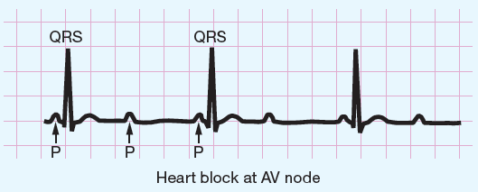 Arrhythmia (ventricular fibrillation)