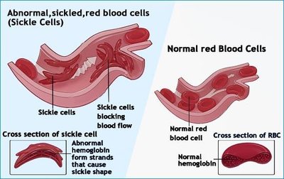 Comparison of sickled and normal red blood cells