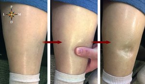 Pitting edema demonstration