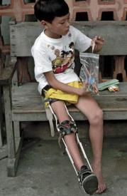 Child with polio leg brace