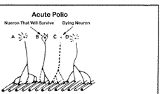 Acute polio motor neuron diagram