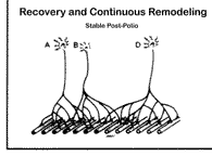 Recovery and continuous remodeling in post-polio