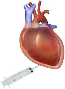 Cardiac tamponade illustration