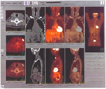PET scan images showing metabolic activity in the body