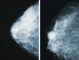 Mammogram showing normal and cancerous breast tissue