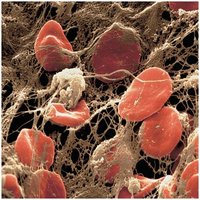 Erythrocytes trapped in a fibrin mesh