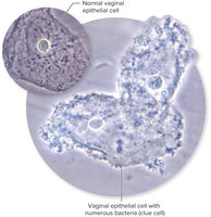 Vaginal epithelial cells with adherent bacteria (clue cells) in bacterial vaginosis