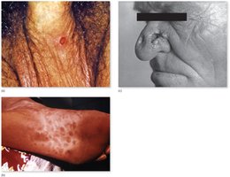 Clinical stages of syphilis: primary chancre, secondary rash, tertiary gummas