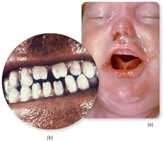 Congenital syphilis: nasal discharge and notched teeth in infants
