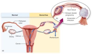 Diagram showing progression of gonorrhea infection in the female reproductive tract, including PID and ectopic pregnancy