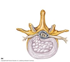 Intervertebral disc structure