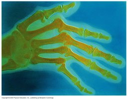 Rheumatoid arthritis in hand joints
