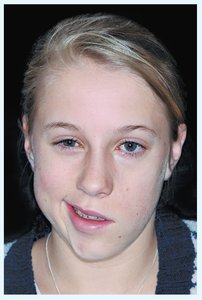 Bell's palsy clinical presentation