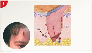Bleeding and inflammatory response in skin injury