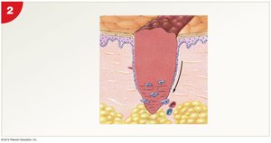 Scab formation and migration of epithelial cells