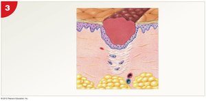 Fibroblast activity and granulation tissue formation