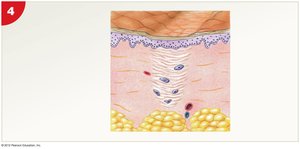 Scar tissue formation after wound healing