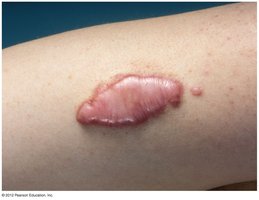 Photograph of a keloid scar
