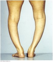 Photo of rickets, a condition caused by vitamin D deficiency