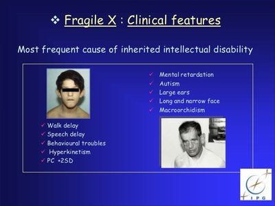 Clinical features of Fragile X syndrome