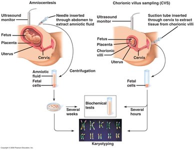 Diagram of amniocentesis and chorionic villus sampling