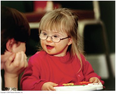Child with Down syndrome