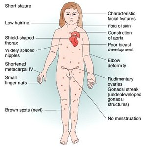 Turner syndrome clinical features diagram