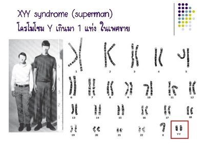Karyotype and features of XYY syndrome