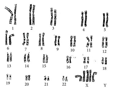Karyotype of a female with multiple X chromosomes