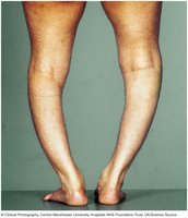 Rickets