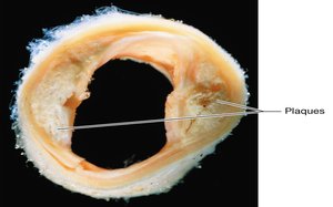 Atherosclerotic plaque in artery