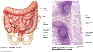 MALT of the intestines