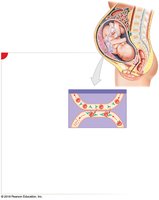 HDN: Second pregnancy, hemolysis of fetal RBCs