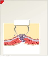 Platelet phase of hemostasis