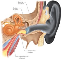 Infected middle ear with bulging eardrum and inflammatory exudate
